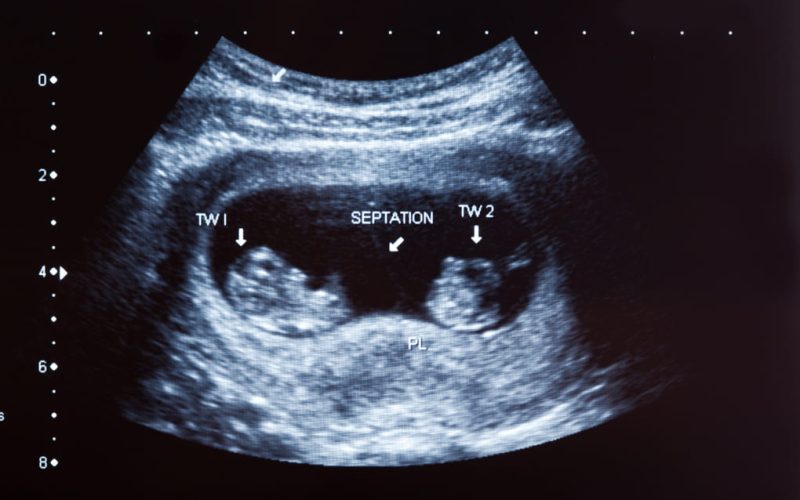 Tratamientos hormonales para aumentar tus probabilidades de embarazo gemelar si eres de  El Salvador